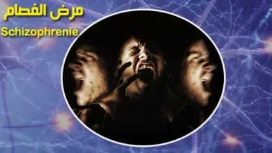 بحث جاهز عن الفصام أو الشيزوفرينيا pdf